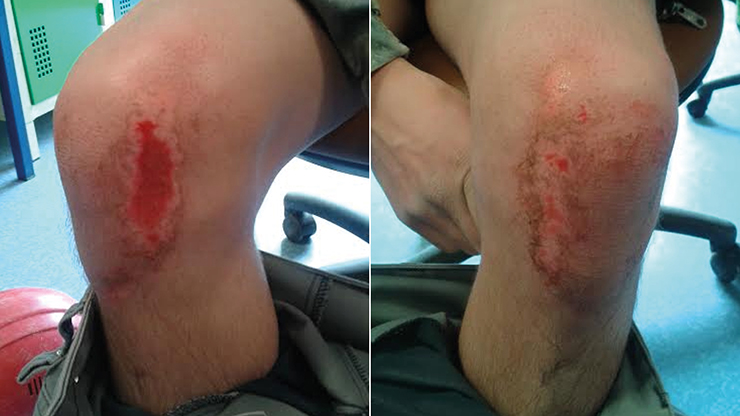 Des brûlures de ciment